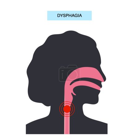 Illustration for Dysphagia medical poster. Difficult or painful swallowing. Esophagus disease concept. Difficulty in the passage of solids or liquids from the mouth to the stomach. Digestive tract problem flat vector - Royalty Free Image