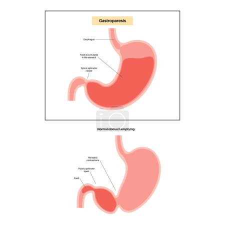 Illustration for Gastroparesis disorder. Delayed gastric emptying concept. muscular contractions of the stomach. Nausea, vomiting, abdominal pain in human body. Diseases of digestive tract flat vector illustration. - Royalty Free Image