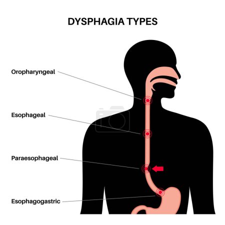 Illustration for Dysphagia medical poster. Difficult or painful swallowing. Esophagus disease concept. Difficulty in the passage of solids or liquids from the mouth to the stomach. Digestive tract problem flat vector - Royalty Free Image