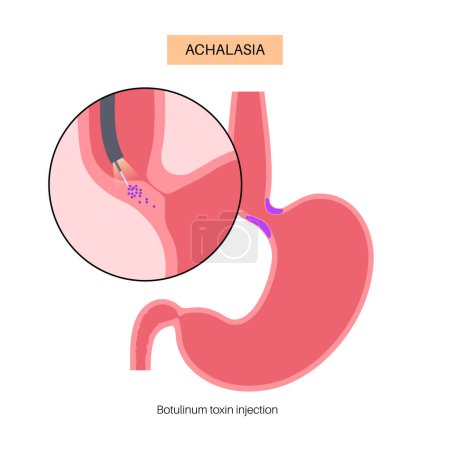 Illustration for Esophageal achalasia disease, botulinum toxin injection treatment. Failure of smooth muscle fibers to relax. Gastrointestinal tract disorder. Closed lower esophageal sphincter, digestive system vector - Royalty Free Image