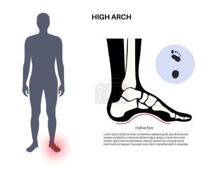 Illustration for Hollow feet medical poster. Abnormal feet arch condition, overpronation, foot deformation and body balance problem. Ankle pathology diagnostic, treatment in podiatry clinic vector illustration - Royalty Free Image