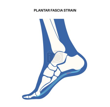 Illustration for Plantar fascia strain anatomical poster. Tear of the soft tissue under the arch of a foot. Ankle disease treatment. Feet ligament injury. Feet pain and swelling. X ray examination vector illustration. - Royalty Free Image