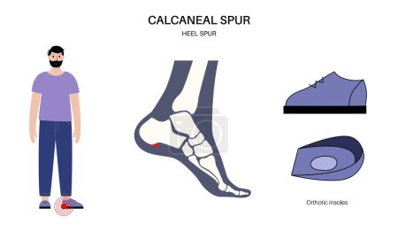 Illustration for Orthotic insoles concept. Discomfort when walking or running. Plantar fasciitis or heel spur treatment. Feet pain, injury, swelling, painful inflammation of the foot isolated flat vector illustration - Royalty Free Image