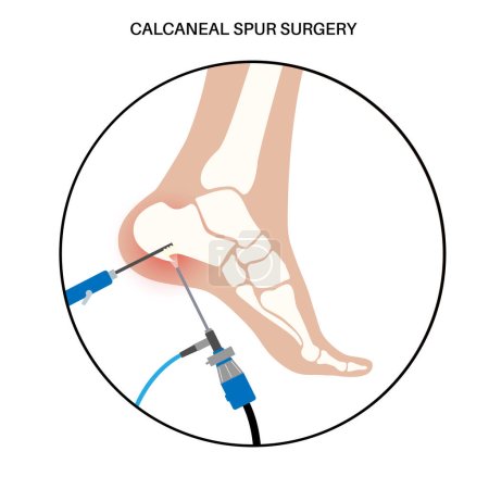 Illustration for Calcaneal spur arthroscopic surgery. Foot problem, diagnostic and treatment. Heel bone outgrowth from calcaneal tuberosity. Ankle pain and swelling. X ray examination of feet flat vector illustration - Royalty Free Image