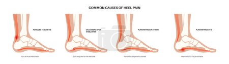 Illustration for Common cause of heel pain. Ankle and foot diseases types diagram. Calcaneal spur, achilles tendinitis, plantar fascia strain, fasciitis treatment. Ankle bones and ligament medical vector illustration - Royalty Free Image