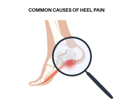 Illustration for Pain of the heel anatomical poster. Ankle and foot diseases. Calcaneal spur, achilles tendinitis, plantar fascia strain or fasciitis treatment. Ankle bones and ligament medical vector illustration - Royalty Free Image