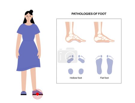 Illustration for Foot pathologies anatomical poster. Flat and hollow feet conditions. Abnormal feet arch, supination and overpronation deformation. Ankle pathology diagnostic in podiatry clinic vector illustration - Royalty Free Image
