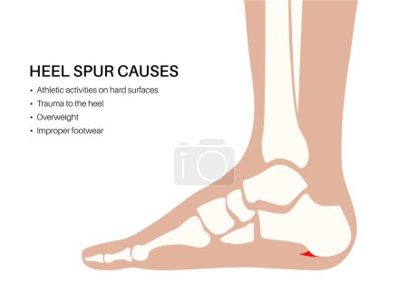 Illustration for Calcaneal spur causes. Foot problem, diagnostic and treatment in podiatry clinic. Heel bone outgrowth from calcaneal tuberosity. Ankle pain and swelling. X ray examination of feet vector illustration - Royalty Free Image