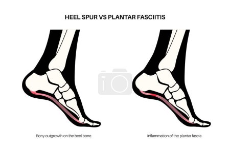 Illustration for Calcaneal spur and plantar fasciitis comparison. Foot diseases treatment. Heel bone outgrowth or feet ligament inflammation. Ankle pain and swelling. X ray examination medical flat vector illustration - Royalty Free Image