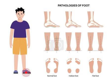 Foot pathologies anatomical poster. Flat, normal and hollow feet conditions. Abnormal feet arch, supination and overpronation. Ankle pathology diagnostic in podiatry clinic medical vector illustration