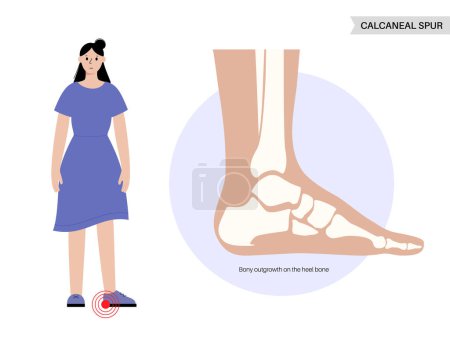 Illustration for Calcaneal spur anatomy. Foot problem, diagnostic and treatment in podiatry clinic. Heel bone outgrowth from calcaneal tuberosity. Ankle pain and swelling. X ray examination of feet vector illustration - Royalty Free Image