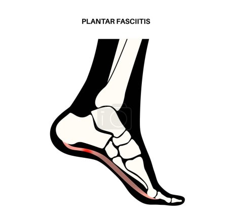 Illustration for Plantar fasciitis anatomical poster. Stretches or tears of plantar fascia. Foot diseases treatment. Feet ligament inflammation. Ankle pain and swelling. X ray examination medical vector illustration. - Royalty Free Image
