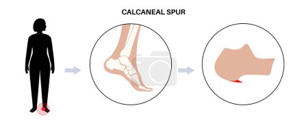 Illustration for Calcaneal spur anatomy. Foot problem, diagnostic and treatment in podiatry clinic. Heel bone outgrowth from calcaneal tuberosity. Ankle pain and swelling. X ray examination of feet vector illustration - Royalty Free Image