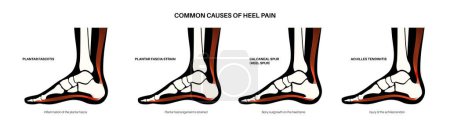 Illustration for Common cause of heel pain. Ankle and foot diseases types diagram. Calcaneal spur, achilles tendinitis, plantar fascia strain, fasciitis treatment. Ankle bones and ligament medical vector illustration - Royalty Free Image