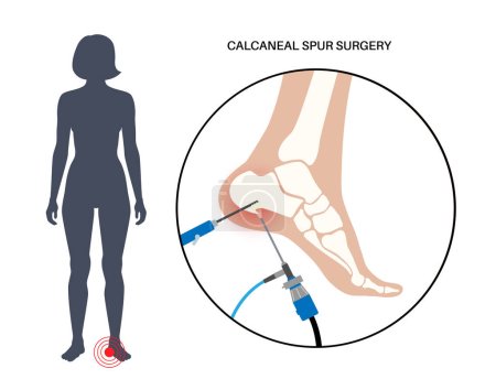 Illustration for Calcaneal spur arthroscopic surgery. Foot problem, diagnostic and treatment. Heel bone outgrowth from calcaneal tuberosity. Ankle pain and swelling. X ray examination of feet flat vector illustration - Royalty Free Image