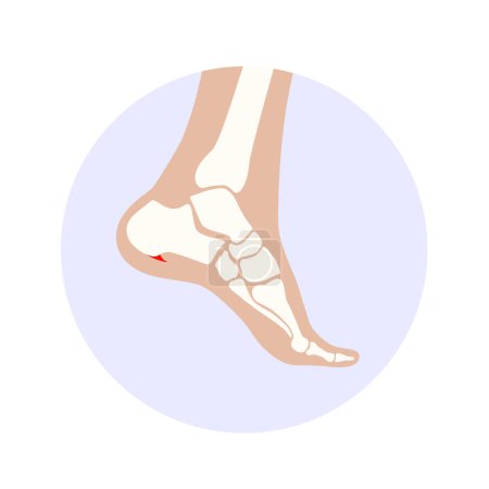Illustration for Calcaneal spur icon. Foot problem, diagnostic and treatment in a podiatry clinic. Heel bone outgrowth from calcaneal tuberosity. Ankle pain and swelling. X ray examination of feet vector illustration - Royalty Free Image