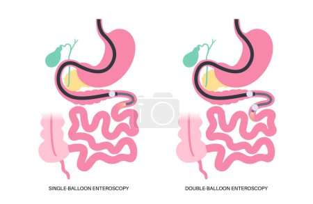 Enteroscopia de balón doble y simple procedimiento mínimamente invasivo. Visualización del intestino delgado. Biopsia, extracción de pólipos, terapia de sangrado o colocación de stent en el tracto gastrointestinal .poster.