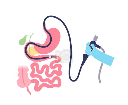 Balloon assisted enteroscopy. Visualization of the small intestine nonsurgical procedure. Gastrointestinal tract exam. Biopsy, polyp removal, bleeding therapy or stent placement vector illustration
