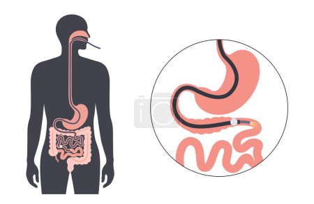 Illustration for Balloon assisted enteroscopy. Visualization of the small intestine nonsurgical procedure. Gastrointestinal tract exam. Biopsy, polyp removal, bleeding therapy or stent placement vector illustration - Royalty Free Image