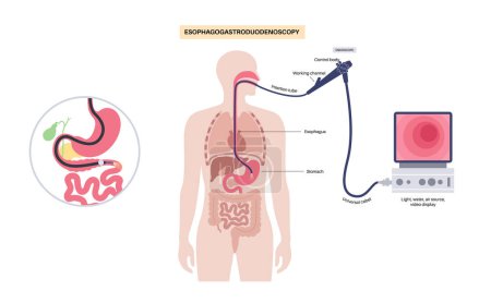 Esophagogastroduodenoscopy medical poster. Diagnostic endoscopic minimally invasive procedure. Visualization of the oropharynx, esophagus, stomach, and proximal duodenum. Gastroenterology flat vector