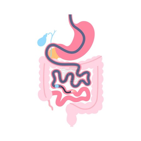 Single balloon enteroscopy procedure. Visualization of the small intestine nonsurgical technique. Gastrointestinal tract problem. Biopsy, polyp removal, bleeding therapy or stent placement flat vector