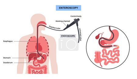 Illustration for Balloon assisted enteroscopy. Visualization of the small intestine nonsurgical procedure. Gastrointestinal tract exam. Biopsy, polyp removal, bleeding therapy or stent placement vector illustration - Royalty Free Image