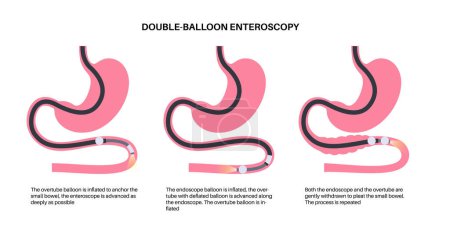 Illustration for Double balloon enteroscopy minimally invasive procedure. Visualization of the small intestine. Biopsy, polyp removal, bleeding therapy, stent placement in gastrointestinal tract .vector illustration. - Royalty Free Image