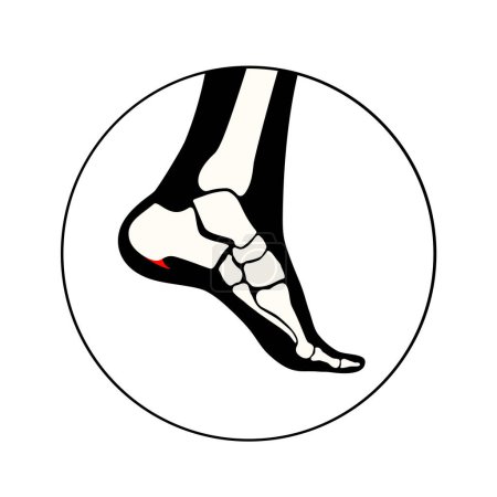 Illustration for Calcaneal spur icon. Foot problem, diagnostic and treatment in a podiatry clinic. Heel bone outgrowth from calcaneal tuberosity. Ankle pain and swelling. X ray examination of feet vector illustration - Royalty Free Image