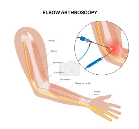 Elbow joint minimally invasive surgery. Arthroscopy medical procedure. Anatomy of humerus, ulna and radius bones. Arm pain, fracture, osteoarthritis or rheumatoid arthritis x ray vector illustration