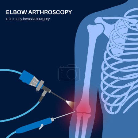 Elbow joint minimally invasive surgery. Arthroscopy medical procedure. Anatomy of humerus, ulna and radius bones. Arm pain, fracture, osteoarthritis or rheumatoid arthritis x ray vector illustration