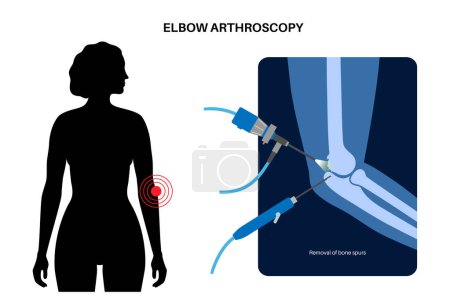 Illustration for Elbow joint minimally invasive surgery. Arthroscopy medical procedure. Anatomy of humerus, ulna and radius bones. Arm pain, fracture, osteoarthritis or rheumatoid arthritis x ray vector illustration - Royalty Free Image
