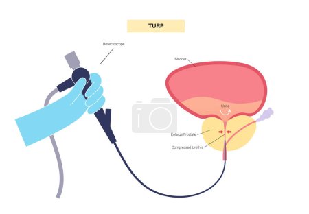 Téléchargez les illustrations : Résection transurétrale de la prostate. Procédure médicale TURP. Retrait chirurgical d'une partie de la prostate. Affiche médicale de traitement de l'HBP. Affiche médicale anatomique de l'illustration vectorielle de la vessie - en licence libre de droit