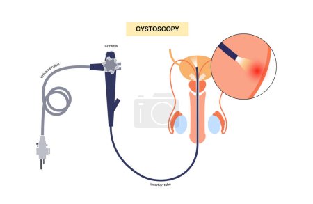 Illustration for Cystoscopy is a minimally invasive procedure. Examination and treatment of the bladder. Disorder of the urinary system, cancer, polyps, stones or inflammation. Urinary tract medical poster flat vector - Royalty Free Image