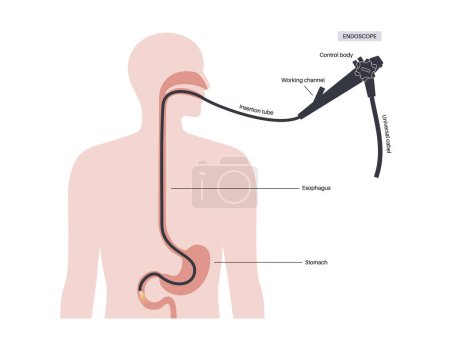 Illustration for Esophagogastroduodenoscopy medical poster. Diagnostic endoscopic minimally invasive procedure. Visualization of the oropharynx, esophagus, stomach, and proximal duodenum. Gastroenterology flat vector - Royalty Free Image