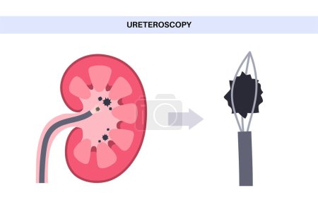 Téléchargez les illustrations : L'urétéroscopie est une procédure minimalement invasive. Examen et traitement du rein. Trouble du système urinaire, cancer, polypes, calculs ou inflammation. Affiche de vecteur médical des voies urinaires - en licence libre de droit