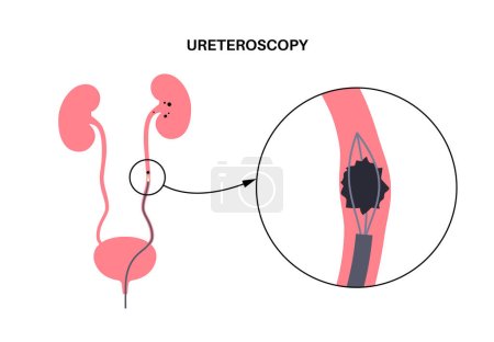 La ureteroscopia es un procedimiento mínimamente invasivo. Examen y tratamiento del riñón. Trastorno del sistema urinario, cáncer, pólipos, cálculos o inflamación. Póster del vector médico del tracto urinario