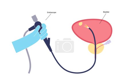 Ilustración de La cistoscopia es un procedimiento mínimamente invasivo. Examen y tratamiento de la vejiga. Trastorno del sistema urinario, cáncer, pólipos, cálculos o inflamación. Vector plano del póster médico del tracto urinario - Imagen libre de derechos
