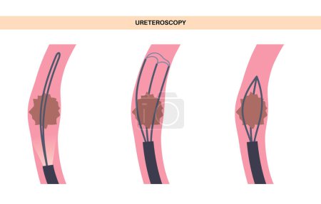 Illustration for Ureteroscopy is a minimally invasive procedure. Examination and treatment of the kidney. Disorder of the urinary system, cancer, polyps, stones or inflammation. Poster of urinary tract medical vector - Royalty Free Image