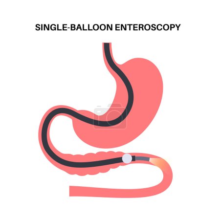 Illustration for Single balloon enteroscopy procedure. Visualization of the small intestine nonsurgical technique. Gastrointestinal tract problem. Biopsy, polyp removal, bleeding therapy or stent placement flat vector - Royalty Free Image