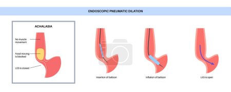 Dilatación neumática endoscópica. Endoscopia superior procedimiento mínimamente invasivo. Trastorno del esófago, terapia para la acalasia. globo interrumpe las fibras musculares en esfínter esofágico inferior cerrado