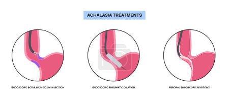 Illustration for Achalasia treatments. Minimally invasive procedures. Closed lower esophageal sphincter. Endoscopic botulinum toxin injection, pneumatic dilation and POEM. Disorder of the esophagus vector illustration - Royalty Free Image