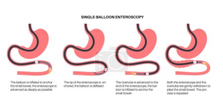 Illustration for Single balloon enteroscopy procedure. Visualization of the small intestine nonsurgical technique. Gastrointestinal tract problem. Biopsy, polyp removal, bleeding therapy or stent placement flat vector - Royalty Free Image