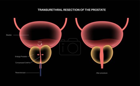 Téléchargez les illustrations : Résection transurétrale de la prostate. Procédure médicale TURP. Retrait chirurgical d'une partie de la prostate. Affiche médicale de traitement de l'HBP. Affiche médicale anatomique de l'illustration vectorielle de la vessie - en licence libre de droit