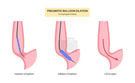 Illustration for Endoscopic pneumatic dilation. Upper endoscopy minimally invasive procedure. Disorder of the esophagus, therapy for achalasia. balloon disrupts the muscle fibers in closed lower esophageal sphincter - Royalty Free Image