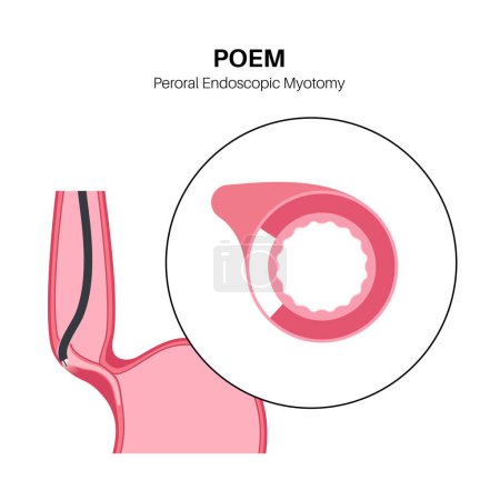 Illustration for Peroral endoscopic myotomy. POEM minimally invasive procedure. Disorder of the esophagus, achalasia disease. Closed lower esophageal sphincter, gastroesophageal anatomical poster vector illustration - Royalty Free Image