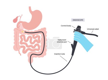 Illustration for Colonoscopy is a minimally invasive procedure. Examination and treatment of the large intestine. Disorder of the colon, polyps, inflammation or swelling of bowel. Gastrointestinal disorder flat vector - Royalty Free Image