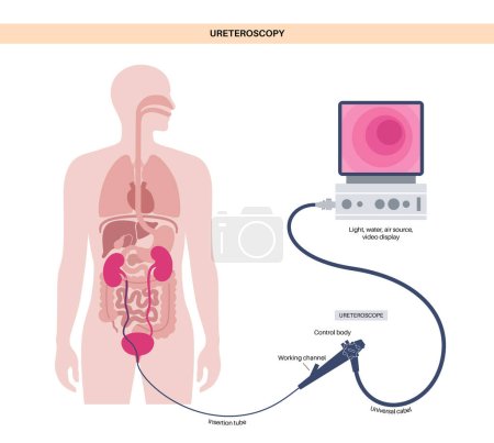 Illustration for Ureteroscopy is a minimally invasive procedure. Examination and treatment of the kidney. Disorder of the urinary system, cancer, polyps, stones or inflammation. Poster of urinary tract medical vector - Royalty Free Image