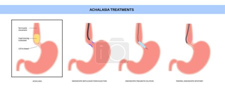 Illustration for Achalasia treatments. Minimally invasive procedures. Closed lower esophageal sphincter. Endoscopic botulinum toxin injection, pneumatic dilation and POEM. Disorder of the esophagus vector illustration - Royalty Free Image