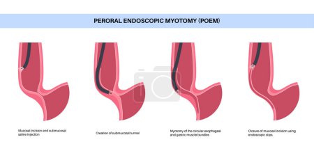 Illustration for Peroral endoscopic myotomy. POEM minimally invasive procedure. Disorder of the esophagus, achalasia disease. Closed lower esophageal sphincter, gastroesophageal anatomical poster vector illustration - Royalty Free Image