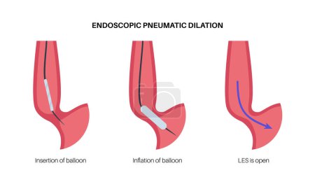 Illustration for Endoscopic pneumatic dilation. Upper endoscopy minimally invasive procedure. Disorder of the esophagus, therapy for achalasia. balloon disrupts the muscle fibers in closed lower esophageal sphincter - Royalty Free Image